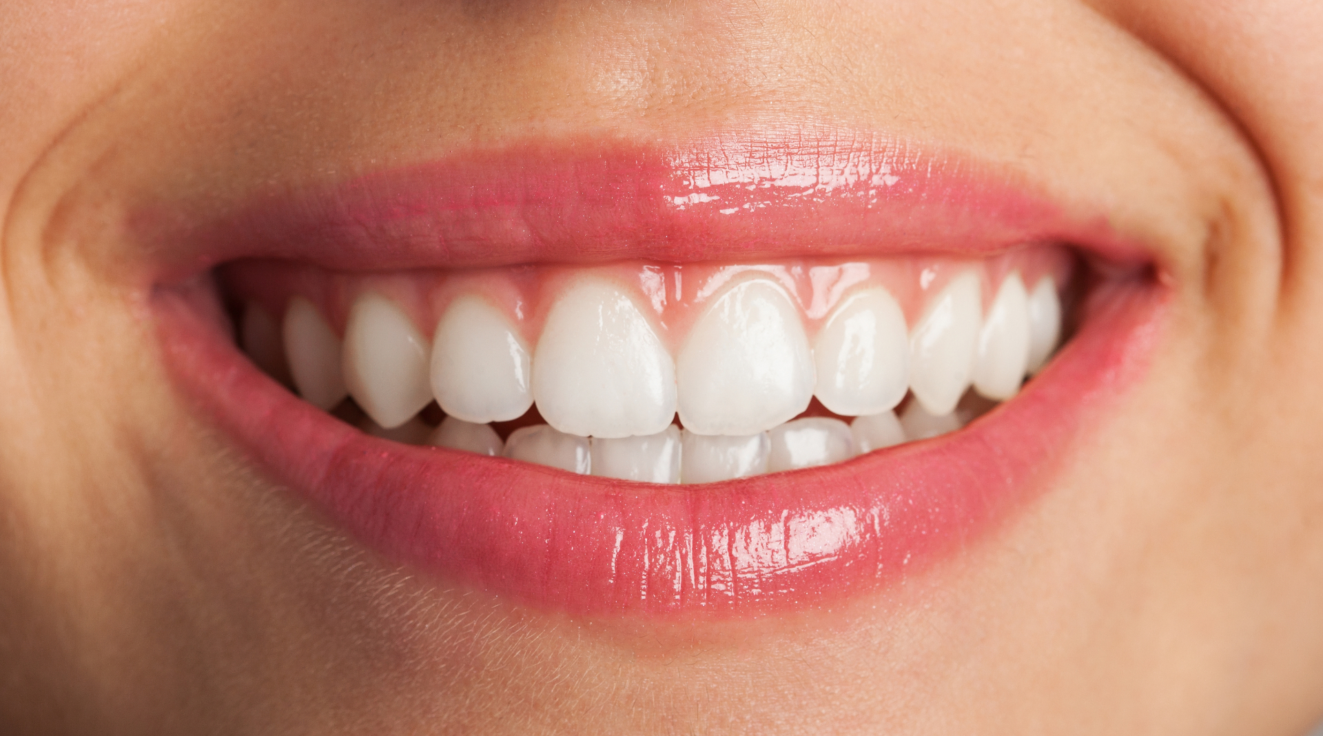 Blanqueamiento Dental 1
