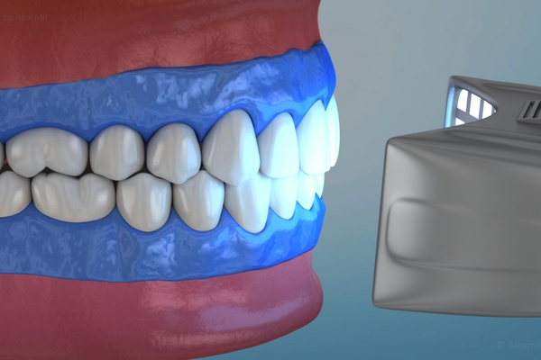 Blanqueamiento Dental 2