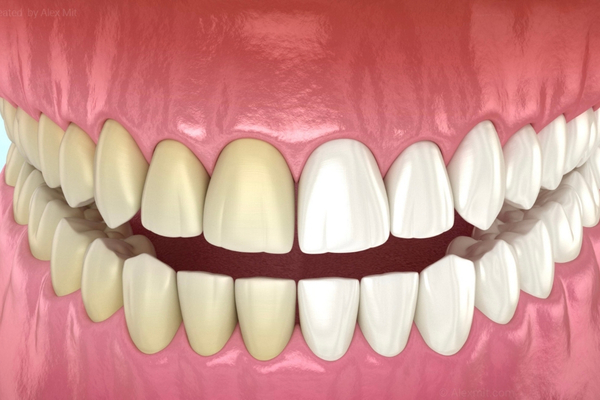 Blanqueamiento Dental 3