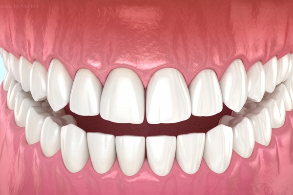 Blanqueamiento Dental 4
