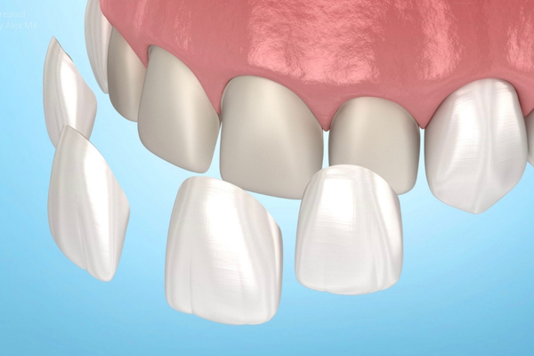 Carillas de Cerámica Dentales 2