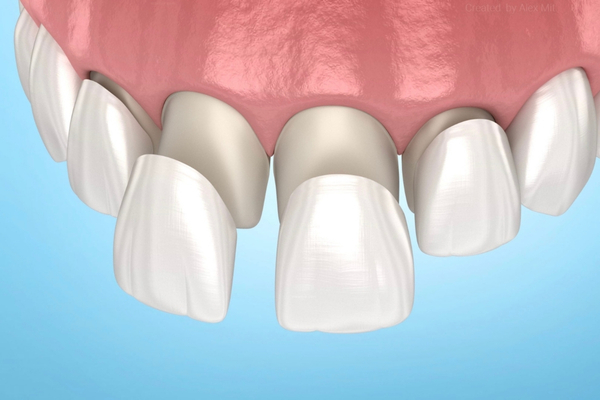 Carillas de Cerámica Dentales 3
