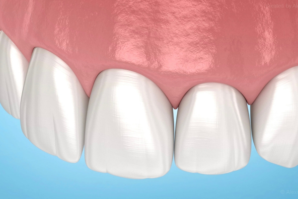 Carillas de Cerámica Dentales 4