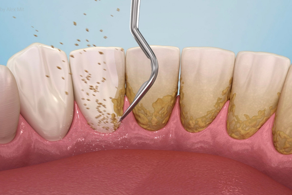 Limpieza Dental 2