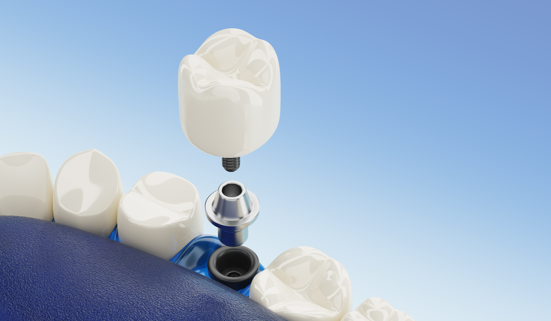 Prótesis e Implantes 1