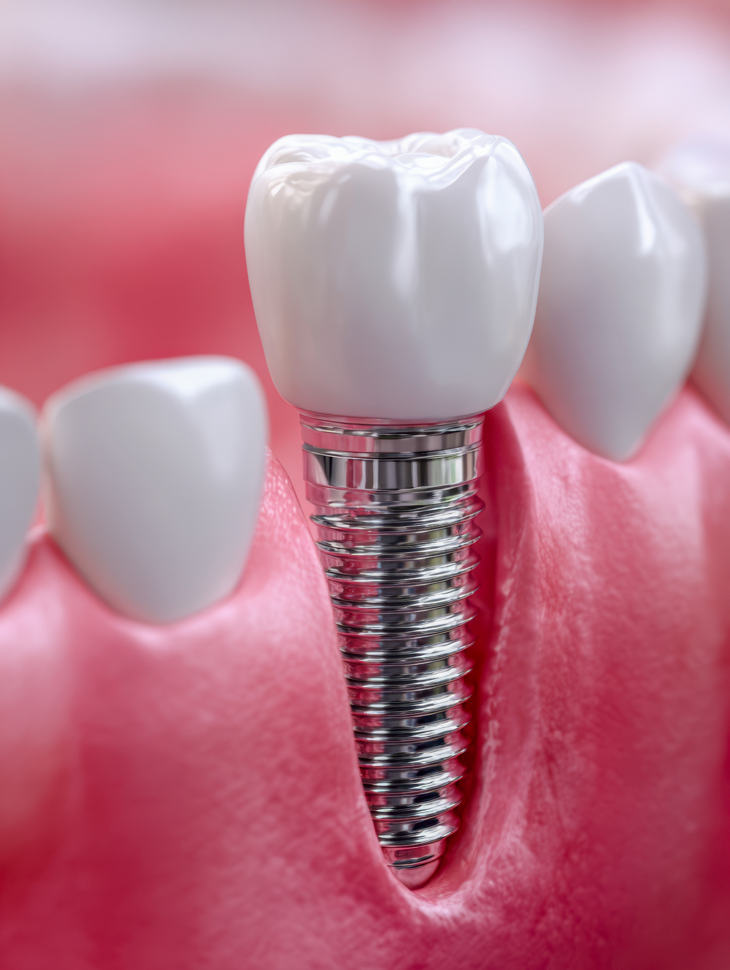 Prótesis e Implantes 2