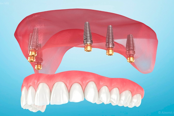 Prótesis e Implantes 2