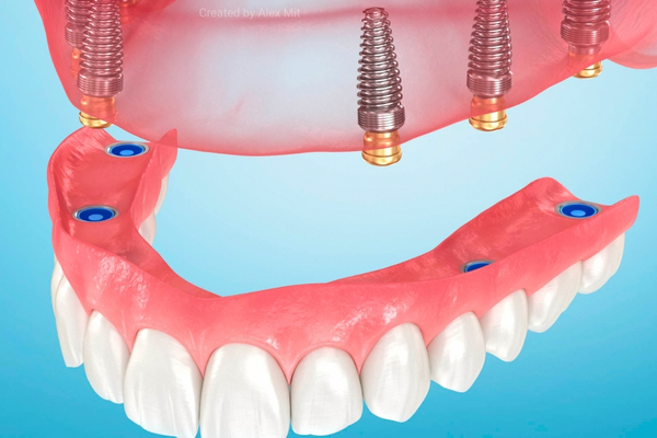 Prótesis e Implantes 3