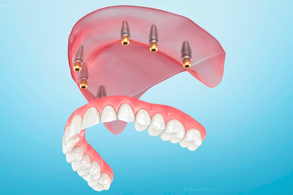 Prótesis e Implantes 4